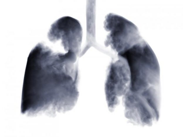 x-ray-of-lungs-with-tumors-showing